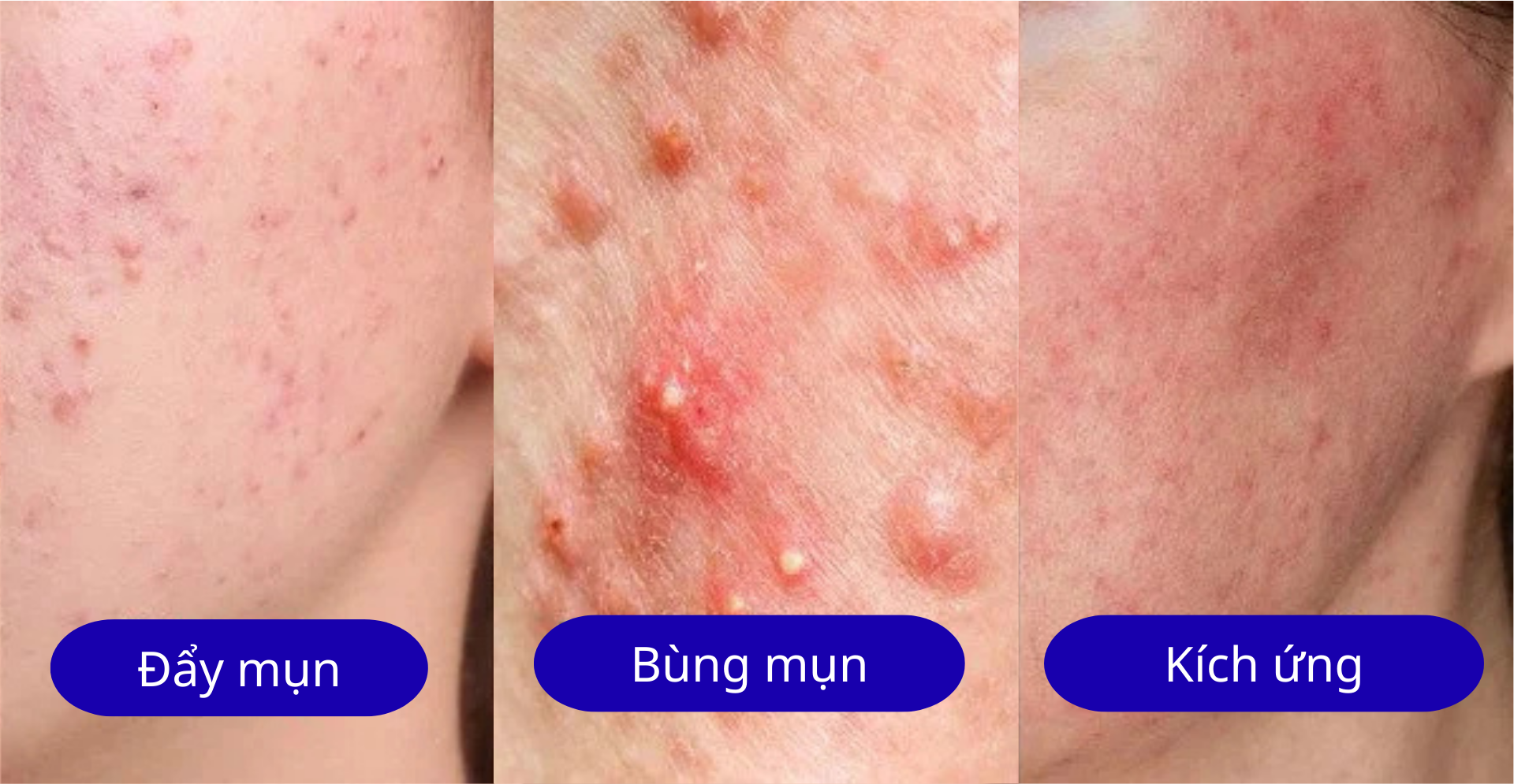 Phân biệt đẩy mụn, bùng mụn và kích ứng