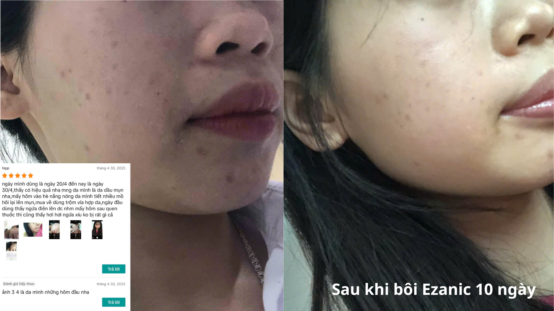 Hiệu quả sau khi bôi Ezanic 10 ngày