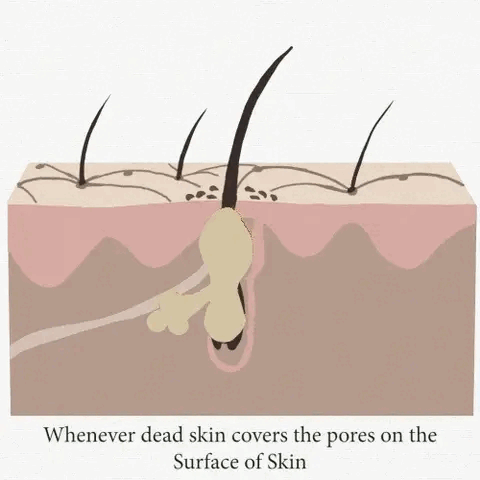 Cơ chế sinh mụn